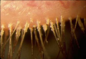 extension ciglia infezione. blefarite.