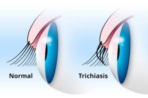 ciglia-e-trichiasi