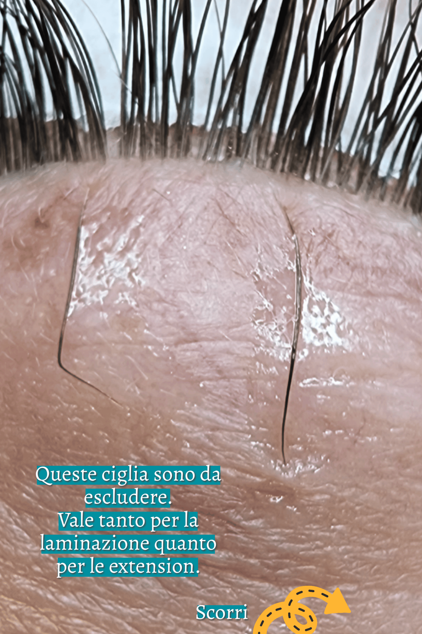 ciglia fuori rima ciglia ciliare, laminazione ciglia, ciglia fuori posizione