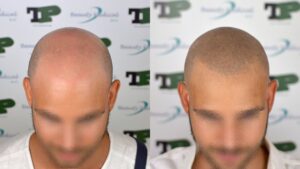 tricopigmentazione